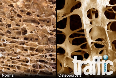 До 10 години болните от остеопороза ще нараснат двойно