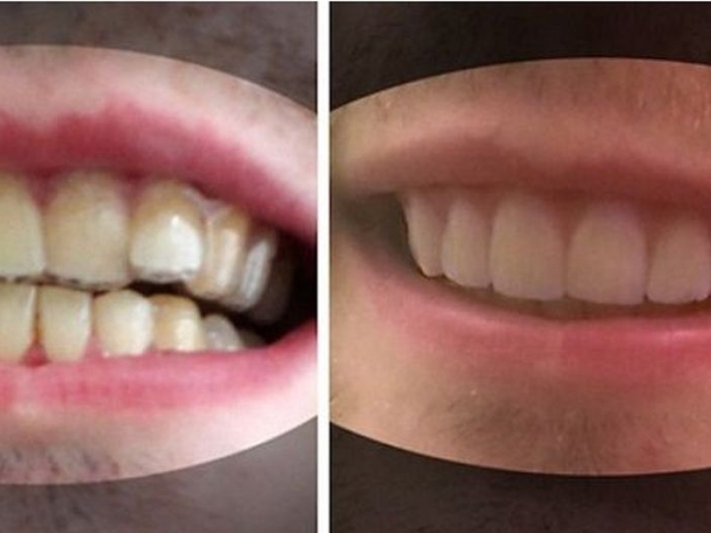 Студент сам си оправи кривите зъби и спести хиляди долари от брекети СНИМКИ