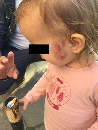 Уволниха медицинска сестра заради нахапаното дете в ясла