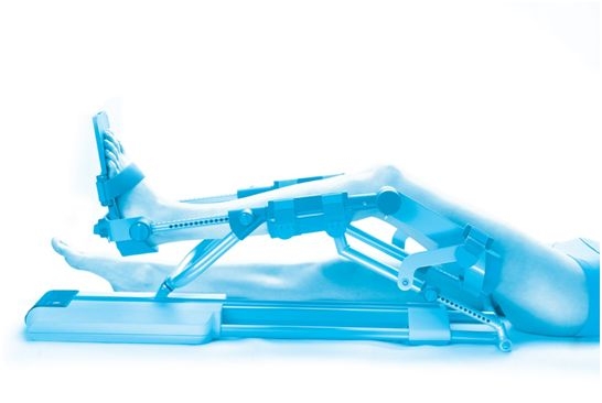 Уникален апарат помага при раздвижване на крайници след счупване и операция