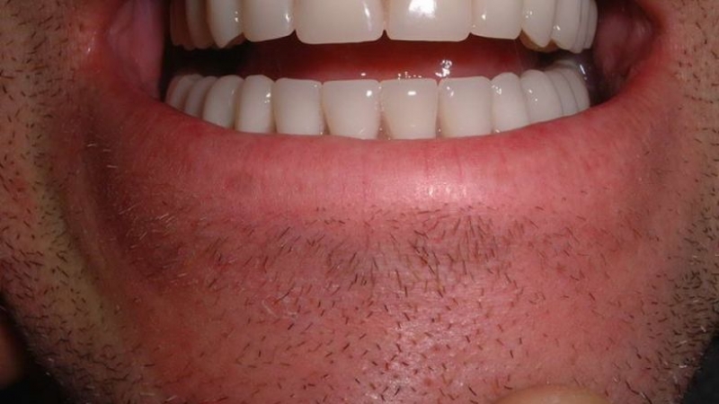 Зъбните протези на възрастните ще ги поема Здравната каса