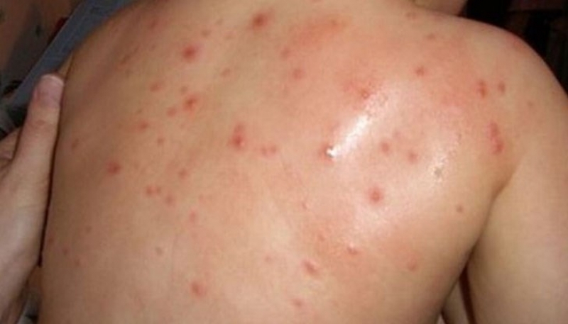 Търсят неваксинирани от морбили деца в Пловдив