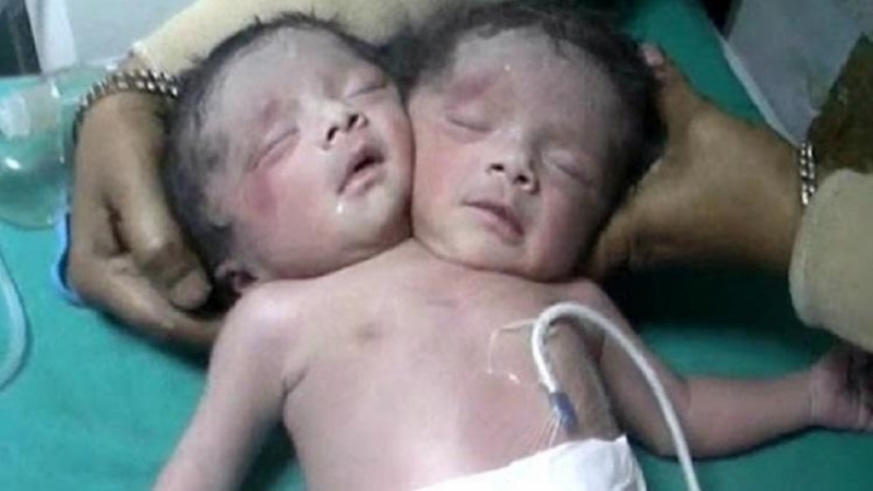 Появи се надежда за сиамските близнаци на 14-годишната майка