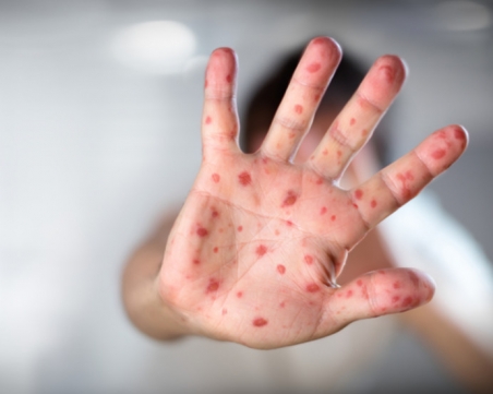 Добра новина: Намалели са болните от варицела в Пловдив