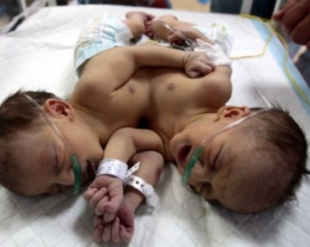 Лоши прогнози за сиамските близнаци от Сливен
