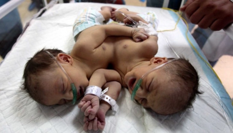 Лоши прогнози за сиамските близнаци от Сливен