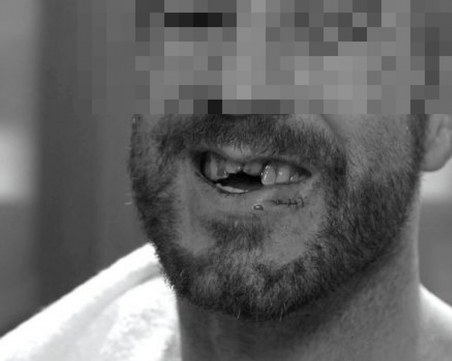 Брутално спънатият бензинджия край Пловдив - с изкъртени зъби и пострадала челюст