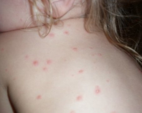 За седмица: Двойно повече болни от скарлатина в Пловдив