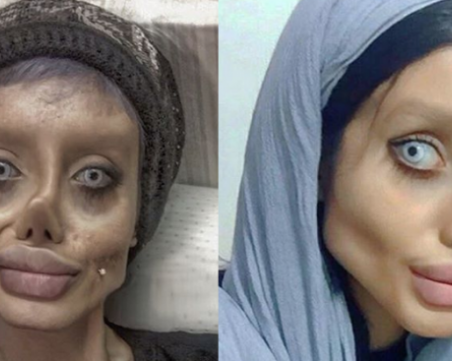 Момиче от Ирак се подложи на 50 пластични операции. Искала да прилича на Анджелина Джоли СНИМКИ