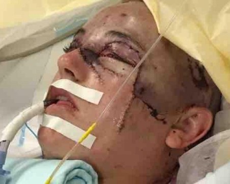 Машина откъсна скалпа на младо момиче