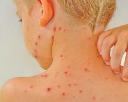 Варицела плъзна в Пловдив, болните скочиха четири пъти