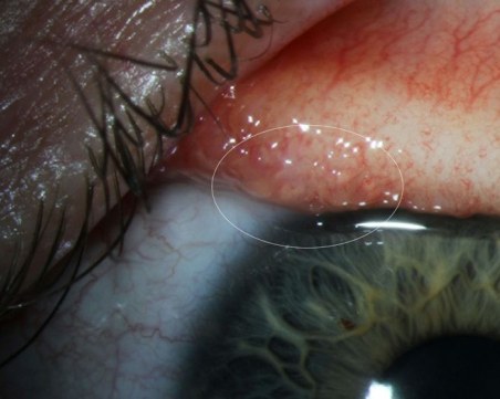 Невероятно операция: Лекари извадиха 14 червея от окото на жена