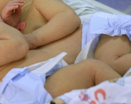 Невероятно: Хирурзи разделиха сиамски близнаци