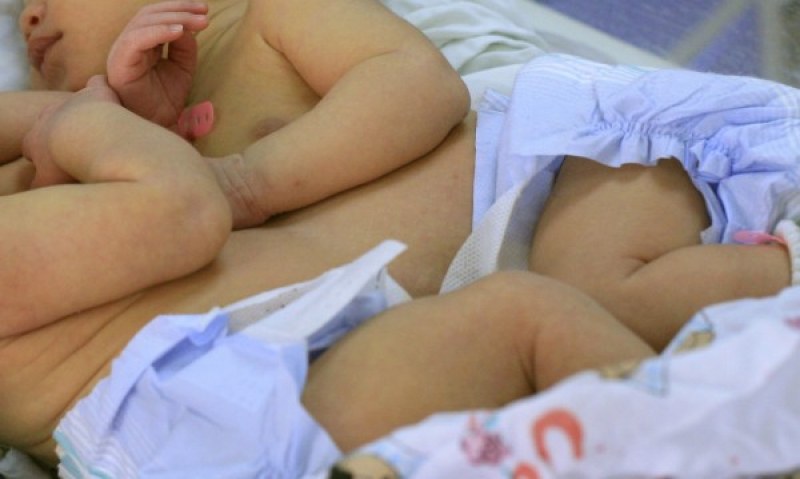 Невероятно: Хирурзи разделиха сиамски близнаци