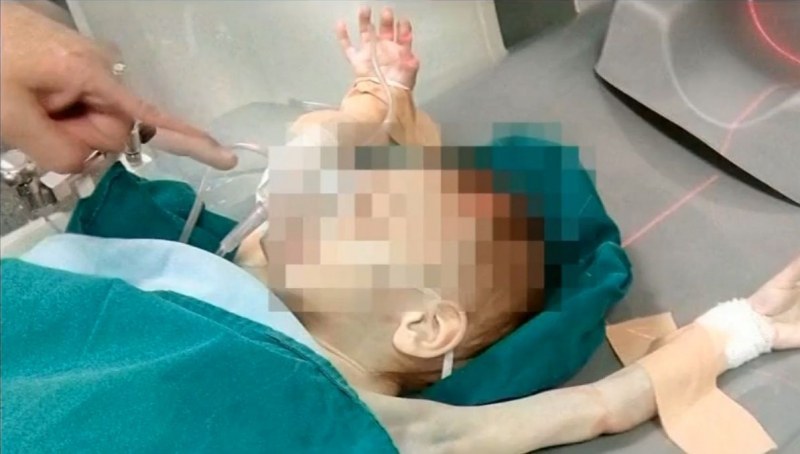 3-годишното момченце, едно от близначетата, е със спукан череп и образувал се хематом ВИДЕО