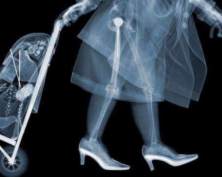 Топ 5: Най-странните неща, намерени в човешкото тяло