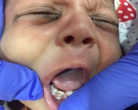 7 зъби извадиха лекари от устата на новородено бебе