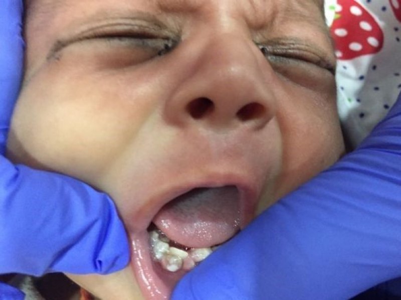 7 зъби извадиха лекари от устата на новородено бебе