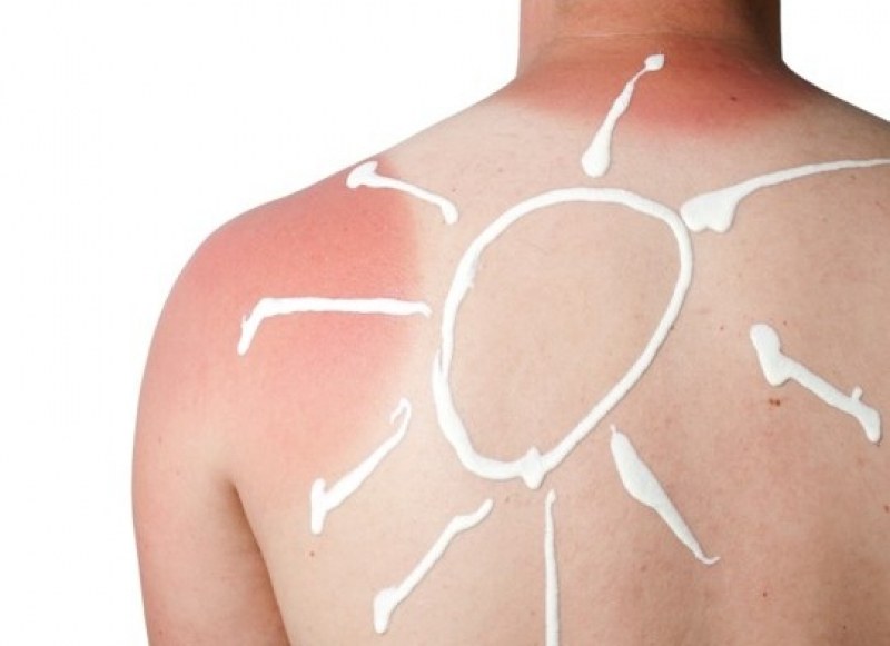 16 трика, които ще ти помогнат при слънчево изгаряне