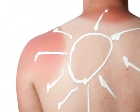 16 трика, които ще ти помогнат при слънчево изгаряне