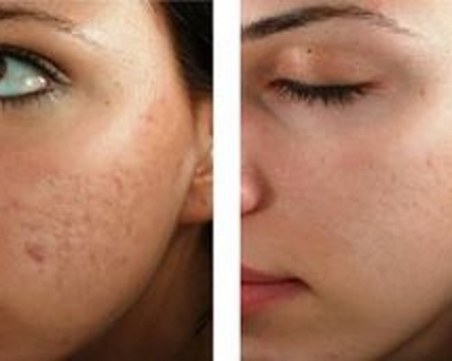 Не ви трябва лазер! С тези евтини подправки белезите ще си отидат