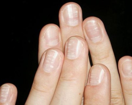 Какво означават белите петънца по ноктите?