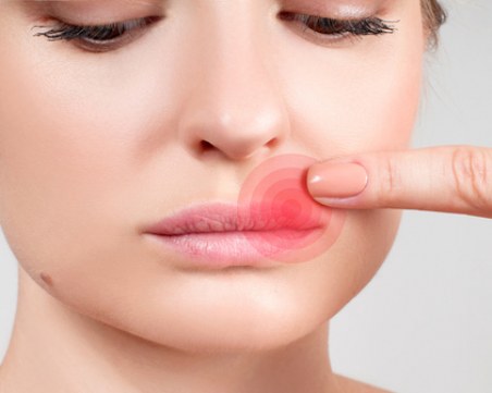 Методи, които ускоряват заздравяването на херпеса