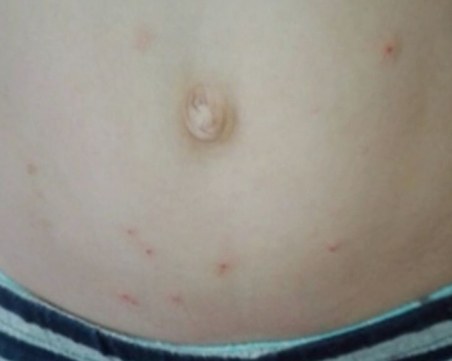 Родители: Децата ни са нахапани от дървеници в детската градина