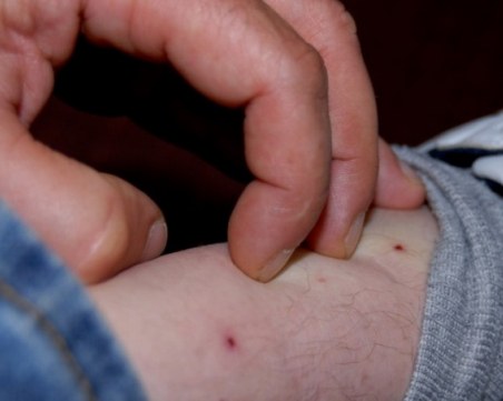 Продължава да расте броят на починалите от западнонилска треска в Гърция