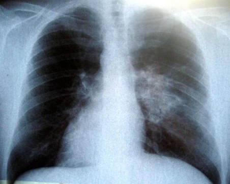 Бум на заболели от пневмония пациенти са регистрирани в Пловдив