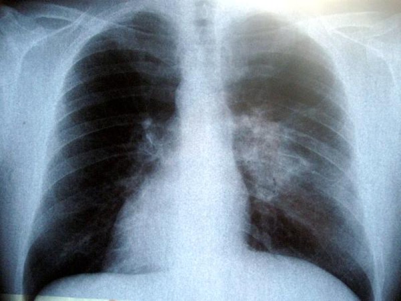 Бум на заболели от пневмония пациенти са регистрирани в Пловдив
