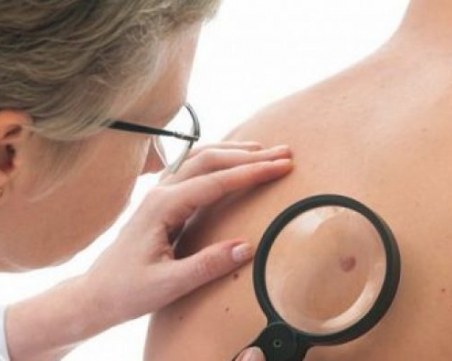 Дерматолози посочиха кои бенки трябва да се отстраняват незабавно