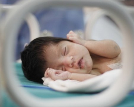 Пет невероятни истории на сиамски близнаци