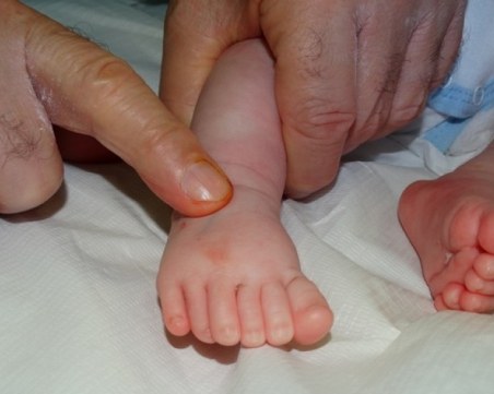 Бебе с шест пръста на всеки крайник бе успешно оперирано в България