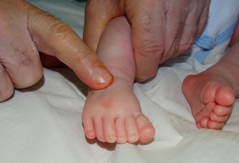 Бебе с шест пръста на всеки крайник бе успешно оперирано в България