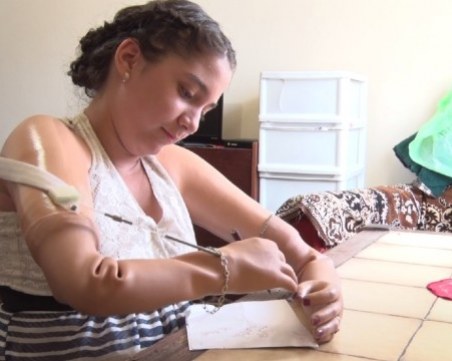 10-годишно момиче без крайници има нужда от нови протези