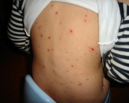 Откриха нови случаи на морбили в Скопие