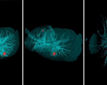 Диагностицират рак за 20 секунди в Русия