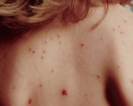 Заразата се разраства и у нас: Жена е покосена от морбили, настанена е в болница в София