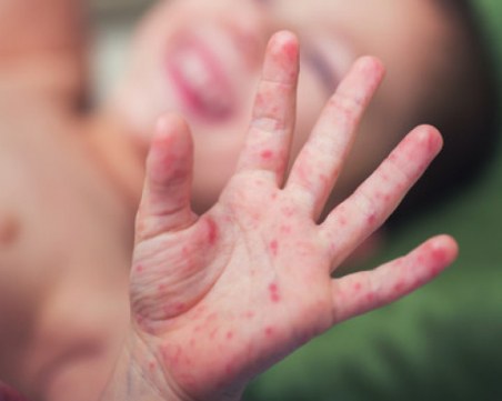 Епидемиолог: При епидемия от морбили винаги има и смъртни случаи