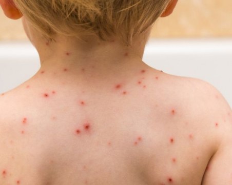 Нови 12 случая на морбили! МЗ потвърди за взрив на заболяването