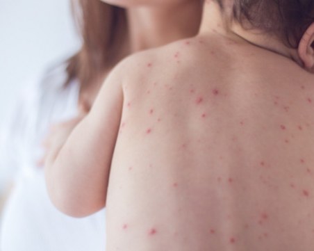 Пет случаи на морбили у нас – повечето в района на Гоце Делчев