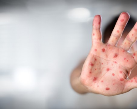 2, 3, 5... 10 случая – взрив на морбили! Колко опасна е болестта?