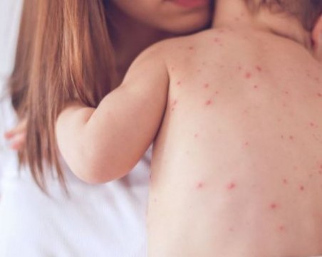 Въвеждат извънредни мерки в Благоевград заради болните от морбили