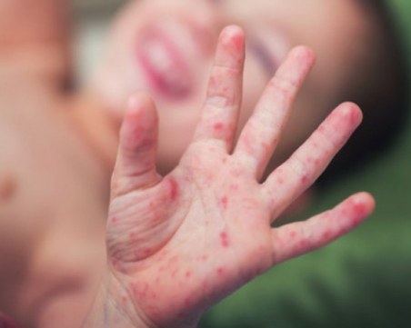 Заради заразата от морбили: спират приема на деца в детските градини в Банско