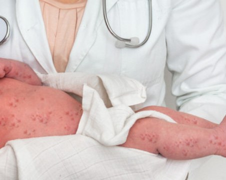 Нови 3 случая! Бебе, малко дете и 19-годишна майка са заразени с морбили в София