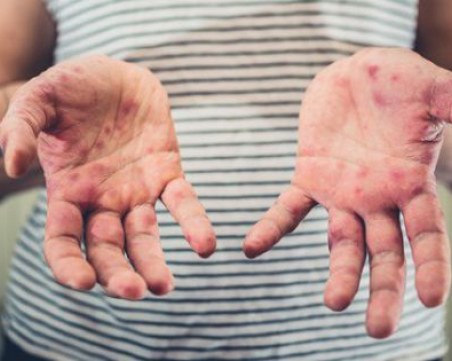 Заразата на морбили е ограничена, но вирусът още циркулира