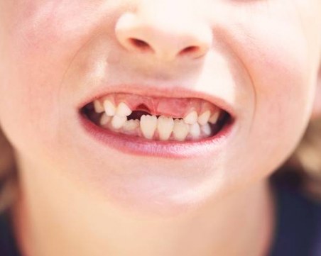 Изваден млечен зъб счупи световен рекорд