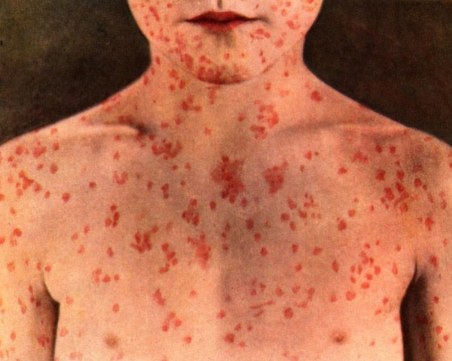 Зараза: 46 души са болни от морбили у нас, вижте къде и кои групи са най-застрашени