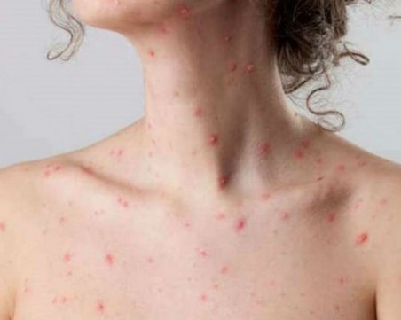 Жена се е разболяла от морбили по време на ски ваканция в Банско